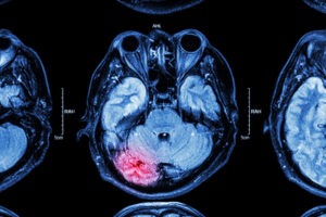 How Do Doctors Diagnose Traumatic Brain Injuries?